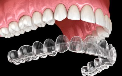 Why Invisalign is clearly the right choice compared to DIY mail-in aligners for straightening teeth