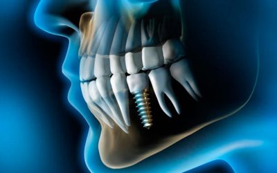 Why are dental implants so expensive? Dental implant placement basic as a step-by-step process